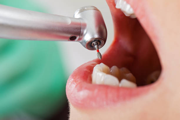 Best Emergency Wisdom Teeth Removal in Pleasant Valley, MO